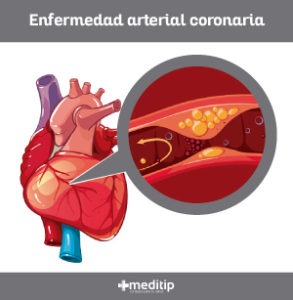 Enfermedad arterial coronaria