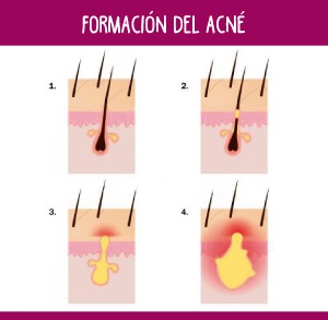 Formación del acné