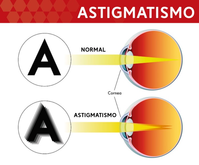 Qué es el astigmatismo