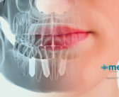 Implantes dentales, una solución definitiva