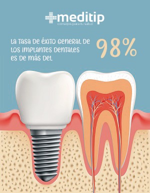 Tasa de éxito de los implantes dentales (98%)