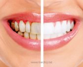 Cómo evitar las manchas dentales