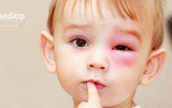 niño con alergia a los insectos