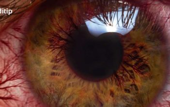 ojo con glaucoma
