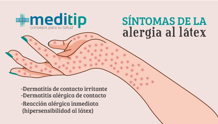 Síntomas de la alergia al látex: Meditip