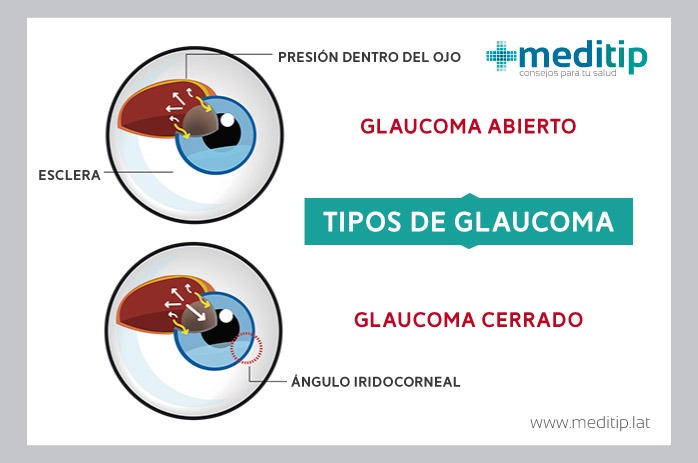 Pruebas de detección de glaucoma: tipos de glaucoma