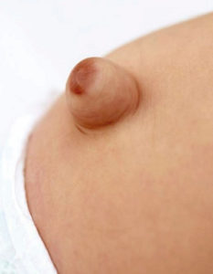 hernia umbilical