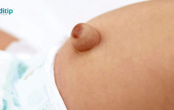 hernia umbilical