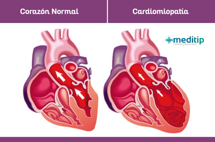 Corazón con cardiomiopatía y corazón normal