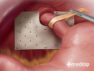 Ilustración de una cirugía de hernia hiatal