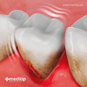 dientes con periodontitis