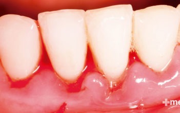 encías con gingivitis