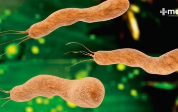 H. pylori , causa de la gastritis , úlcera