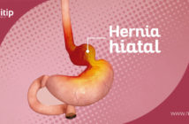 hernia hiatal
