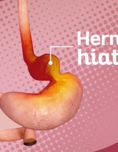 hernia hiatal