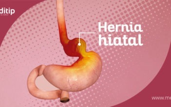 hernia hiatal