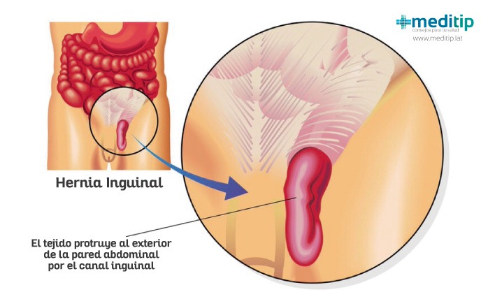 ilustración de una hernia inguinal