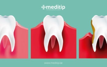 Enfermedad periodontal