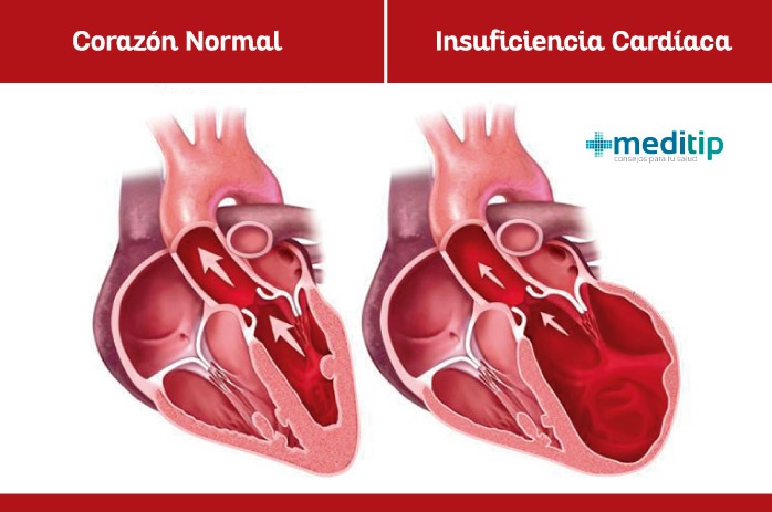 Corazón con insuficiencia cardiaca y corazón normal