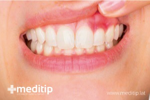 boca mostrando encías con gingivitis
