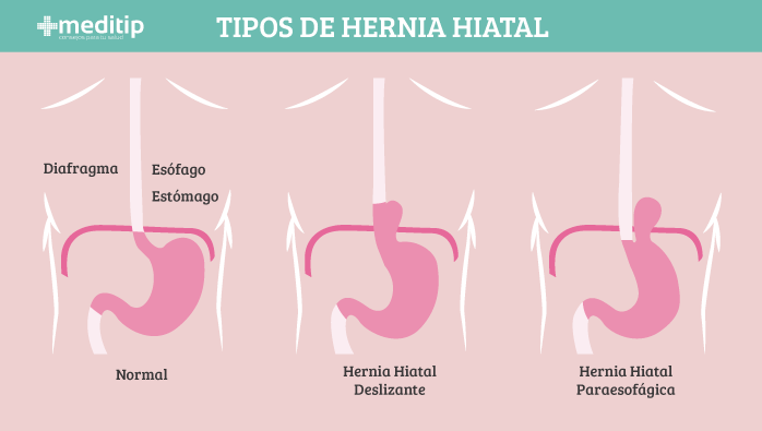 Tipos de hernias hiatales