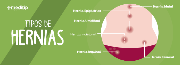 tipos de hernias