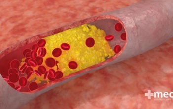 Sistema circulatorio: colesterol alto