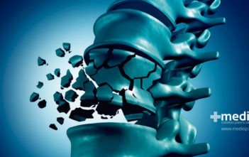 Causas del dolor de espalda: fractura vertebral