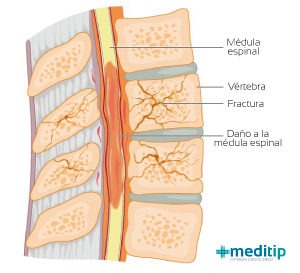 fractura vertebral