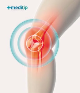 imagen de rodilla con osteoartritis