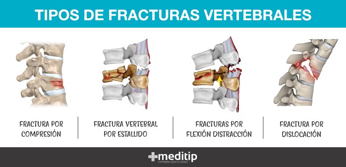 Tipos de fracturas vertebrales