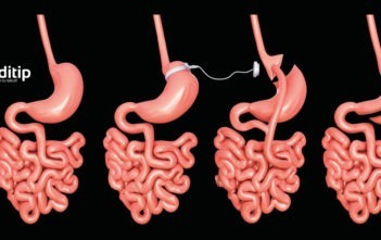 cirugía bariátrica