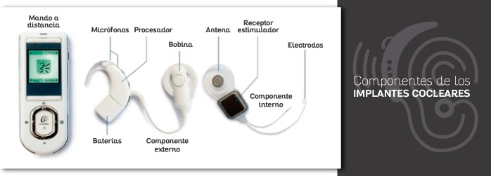 Componentes de un implante coclear