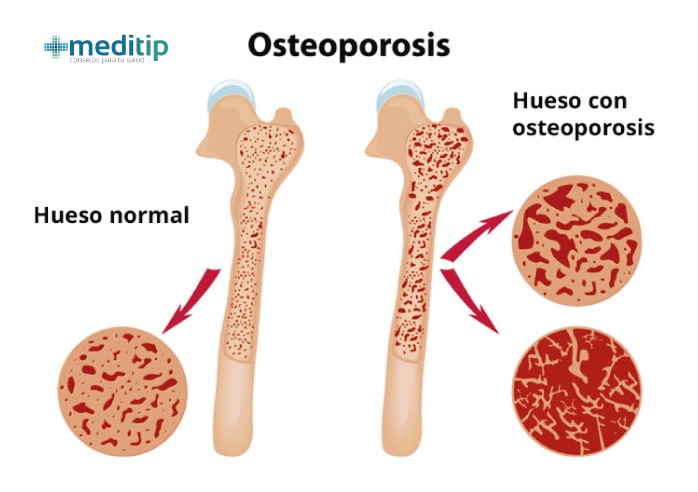 Osteoporosis por artritis