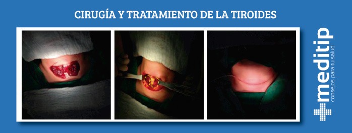 cirugía y tratamiento de la tiroides