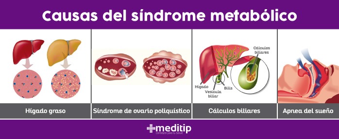 Causas del síndrome metabólico
