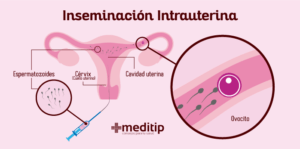 Inseminación intrauterina