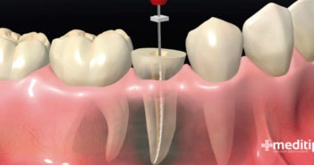 Endodoncia: tratamiento y procedimiento