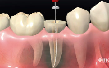 Tratamiento de endodoncia