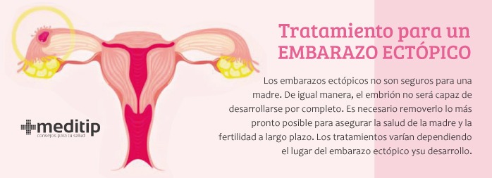 Tratamiento para el embarazo ectópico