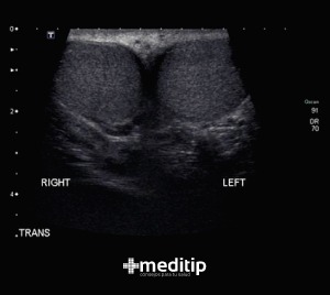 Ultrasonido escrotal