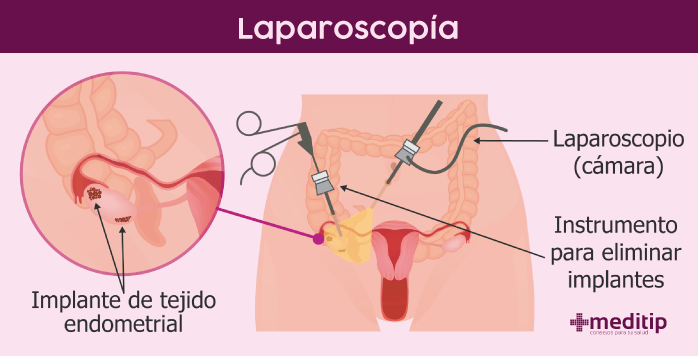 Laparoscopia para una edometriosis