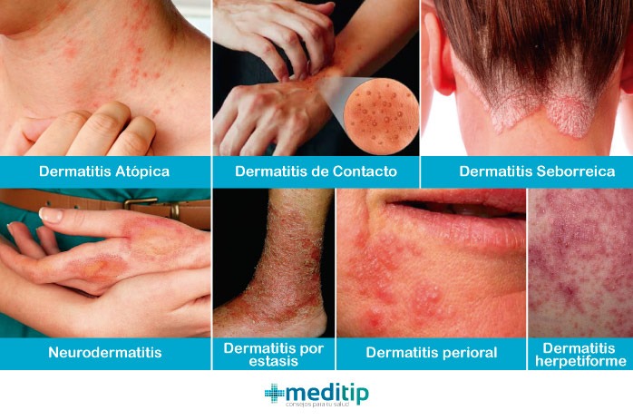 Tipos de dermatitis