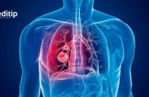 Cómo tratar la tuberculosis