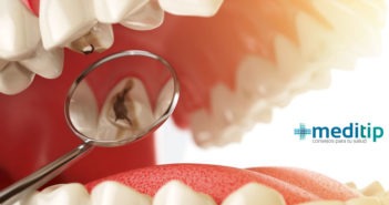 Caries dental: definición, causas y diagnóstico