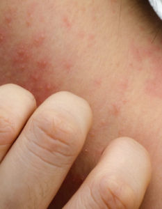 Dermatitis de contacto