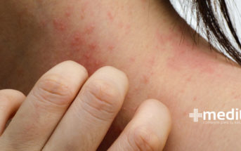 Dermatitis de contacto