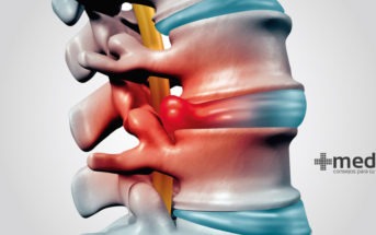 Hernia de disco