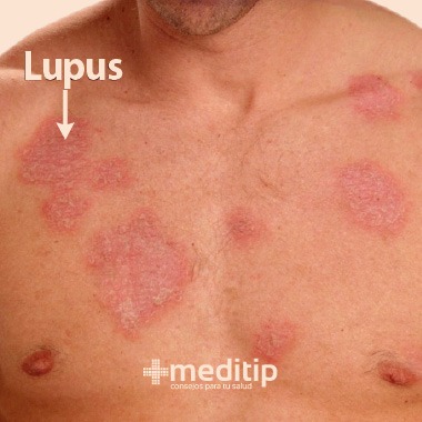 Sarpullido por lupus