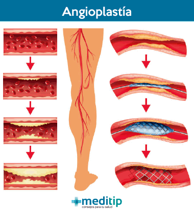 Tratamiento de la enfermedad arterial periférica: angioplastía